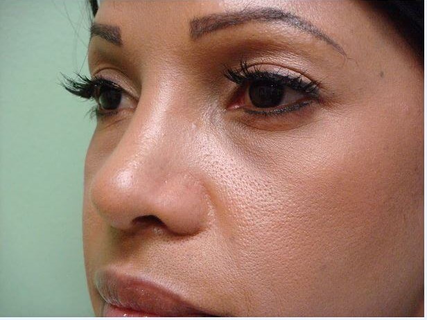 Rhinoplasty with Implant After