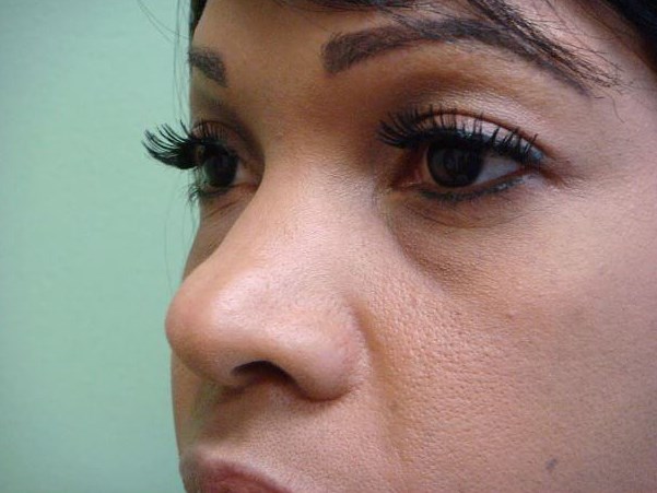 Rhinoplasty with Implant Before
