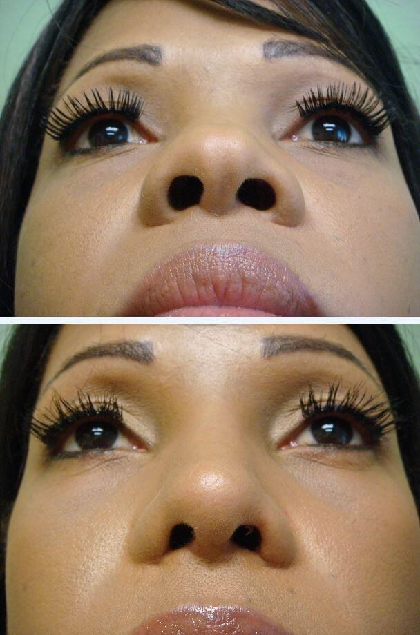 Rhinoplasty with Implant Before