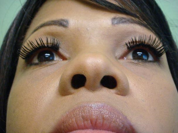 Rhinoplasty with Implant Before