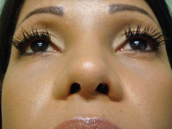 Rhinoplasty with Implant After