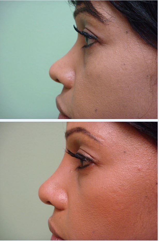 Rhinoplasty with Implant Before