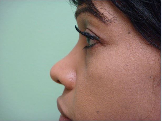 Rhinoplasty with Implant Before