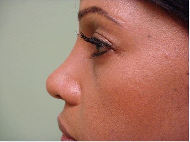 Rhinoplasty with Implant After