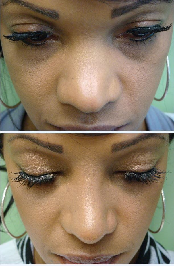 Rhinoplasty with Implant Before