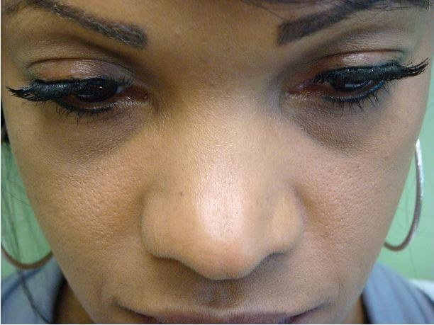 Rhinoplasty with Implant Before
