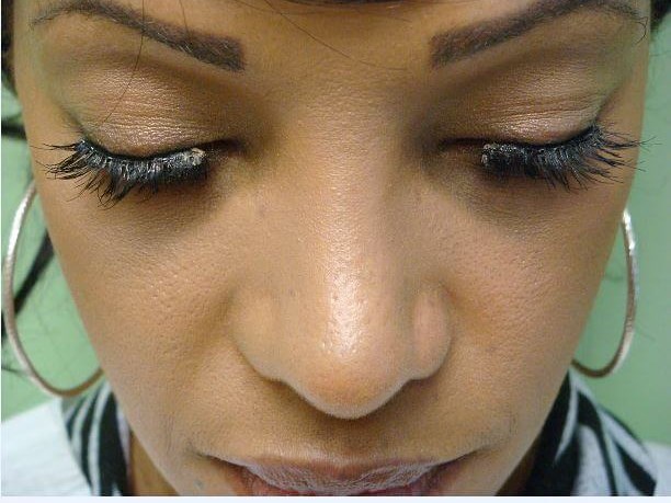 Rhinoplasty with Implant After