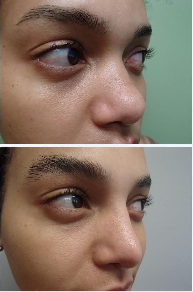 Rhinoplasty with Implant Before