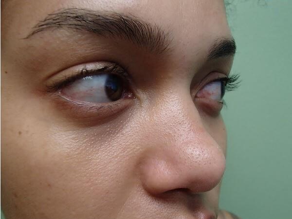 Rhinoplasty with Implant Before