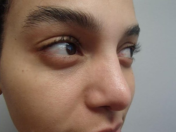 Rhinoplasty with Implant After