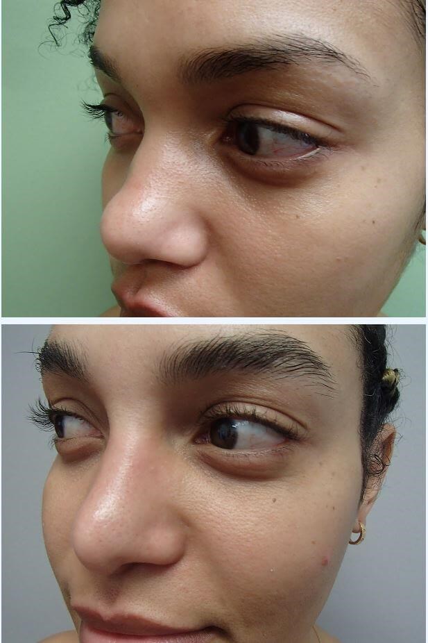 Rhinoplasty with Implant Before