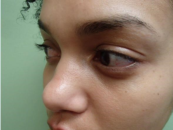 Rhinoplasty with Implant Before