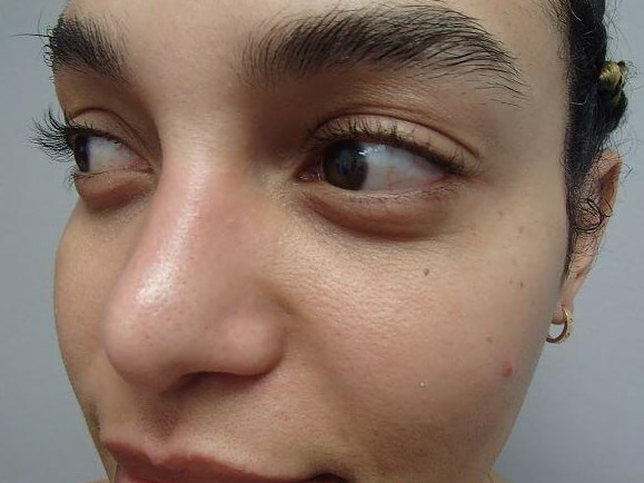 Rhinoplasty with Implant After