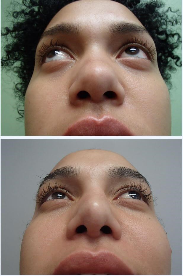 Rhinoplasty with Implant Before