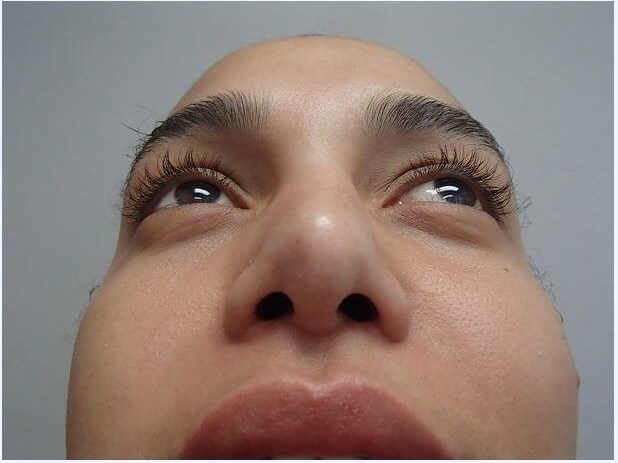 Rhinoplasty with Implant After