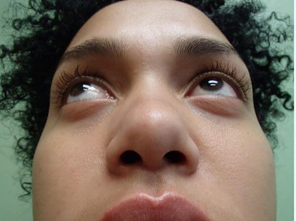 Rhinoplasty with Implant Before