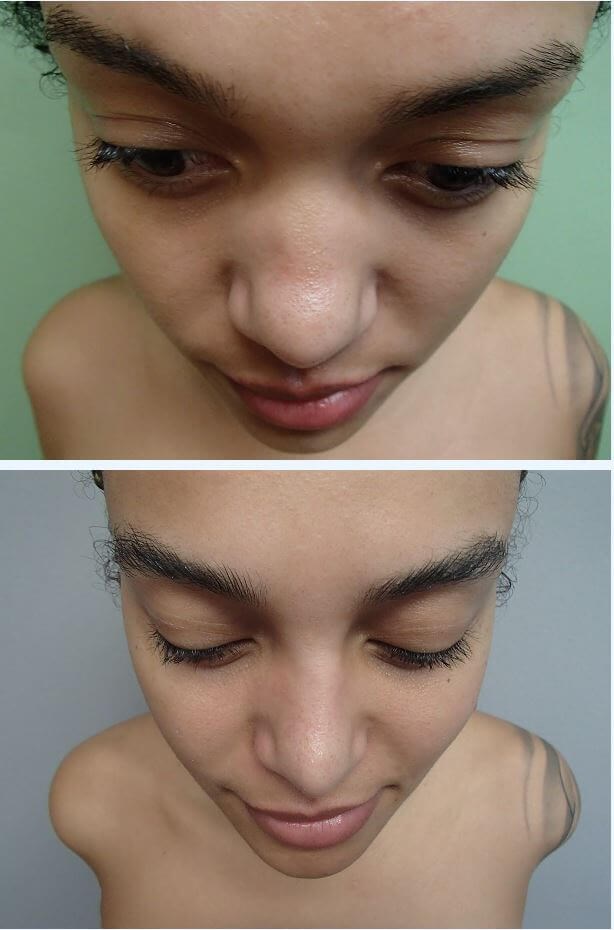 Rhinoplasty with Implant Before