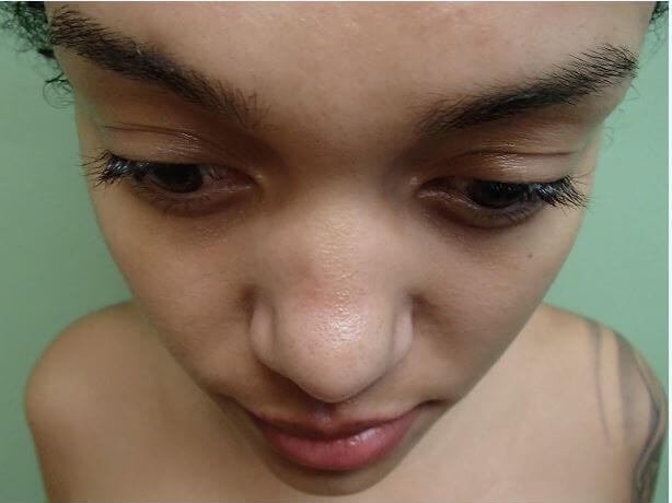 Rhinoplasty with Implant Before