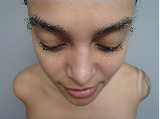 Rhinoplasty with Implant After