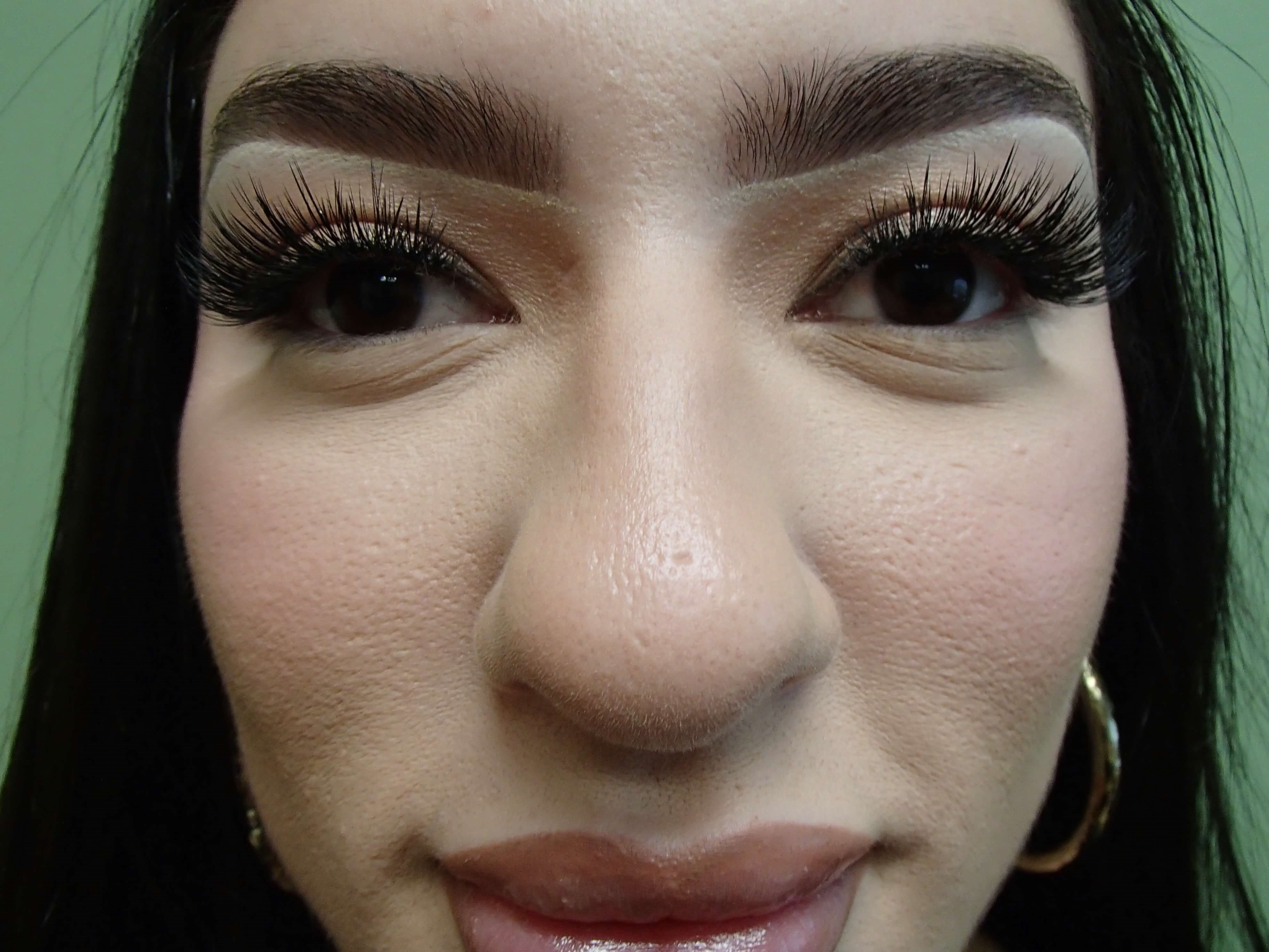 Rhinoplasty (Nose Job) Before