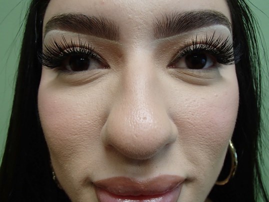 Rhinoplasty (Nose Job) Before