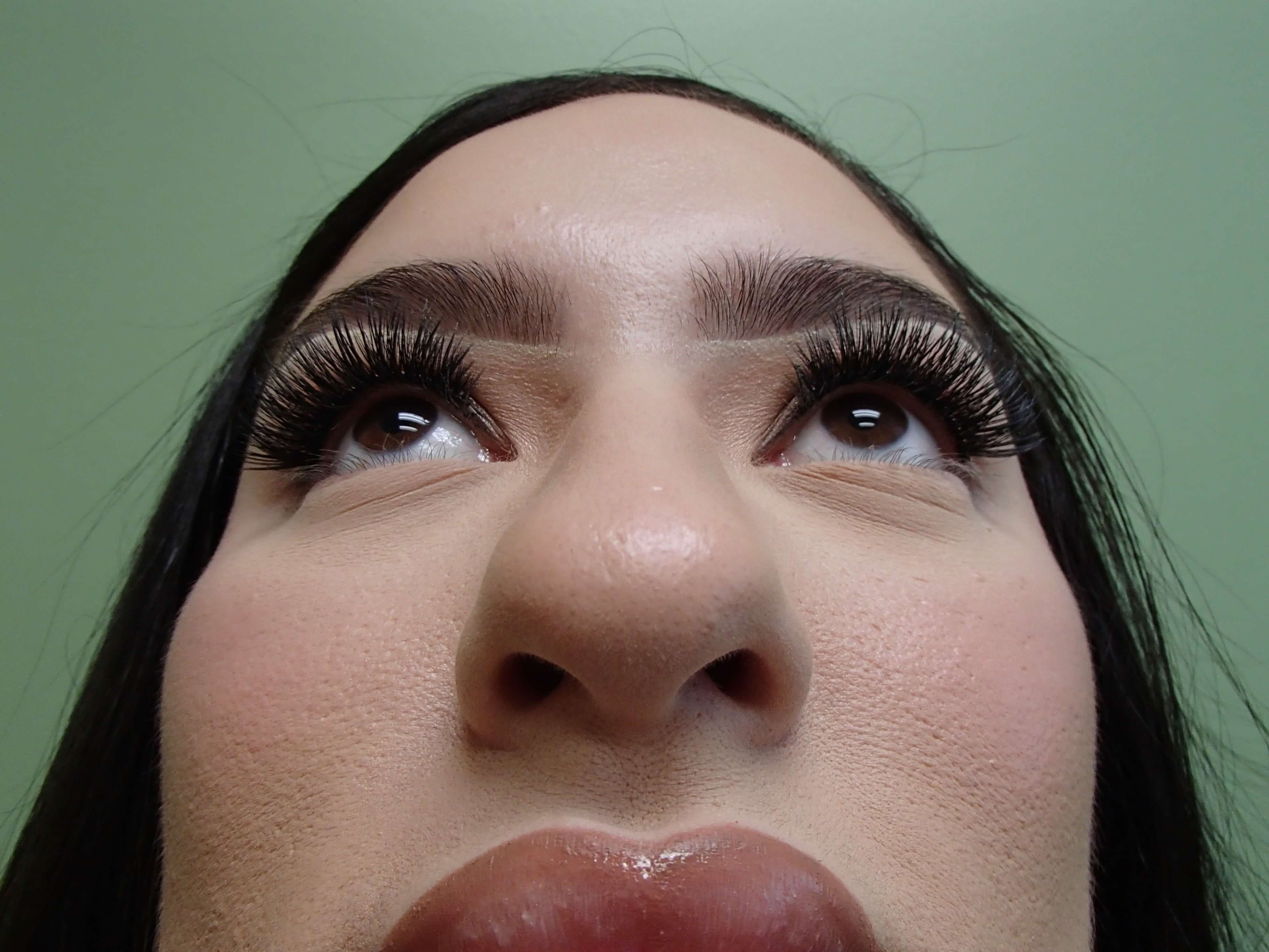 Rhinoplasty (Nose Job) Before