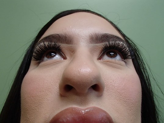 Rhinoplasty (Nose Job) Before