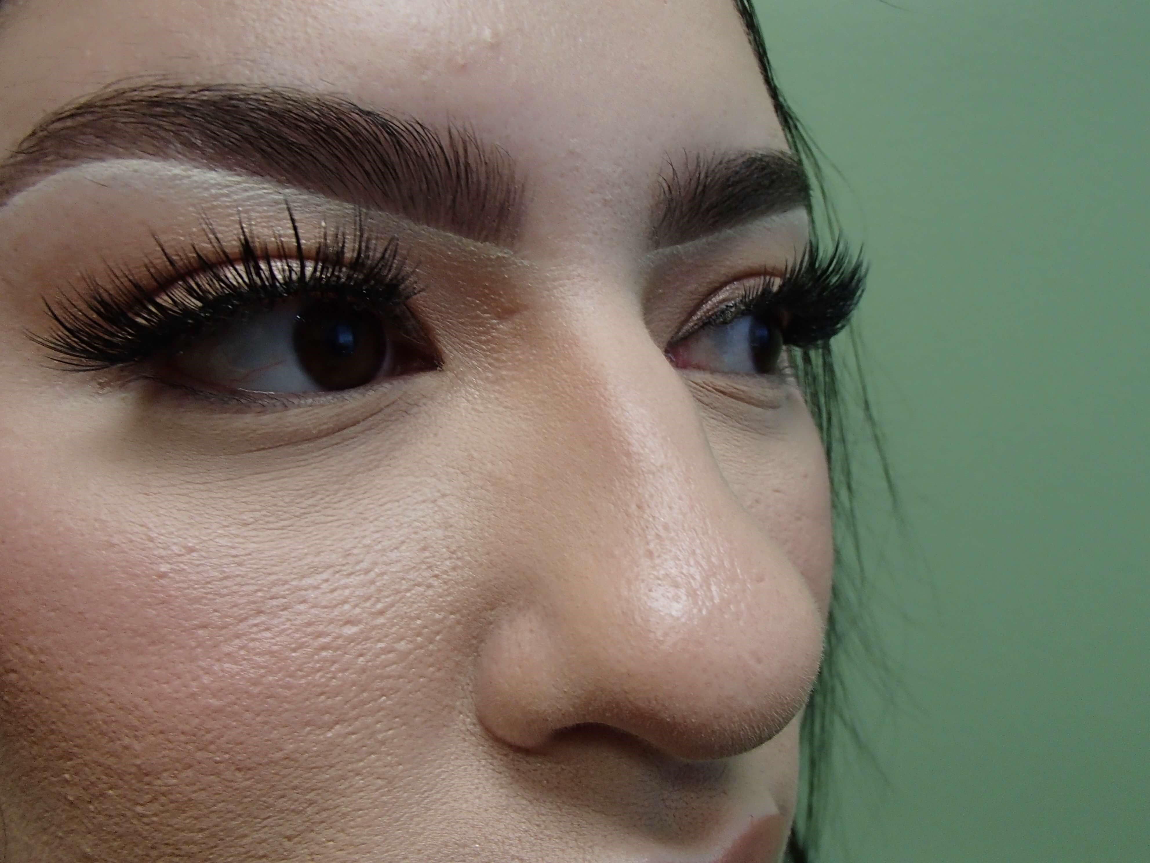 Rhinoplasty (Nose Job) Before