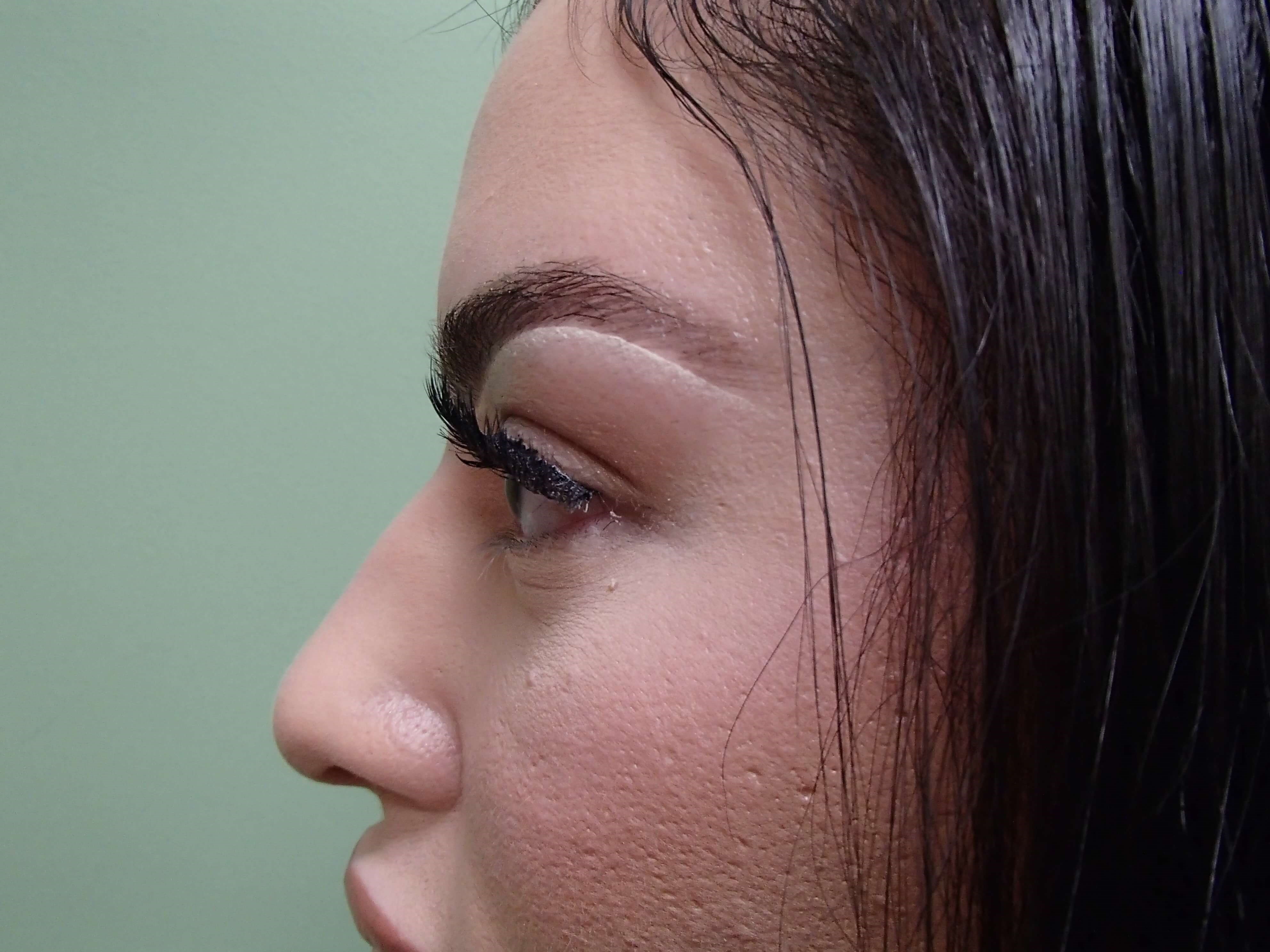 Rhinoplasty (Nose Job) Before