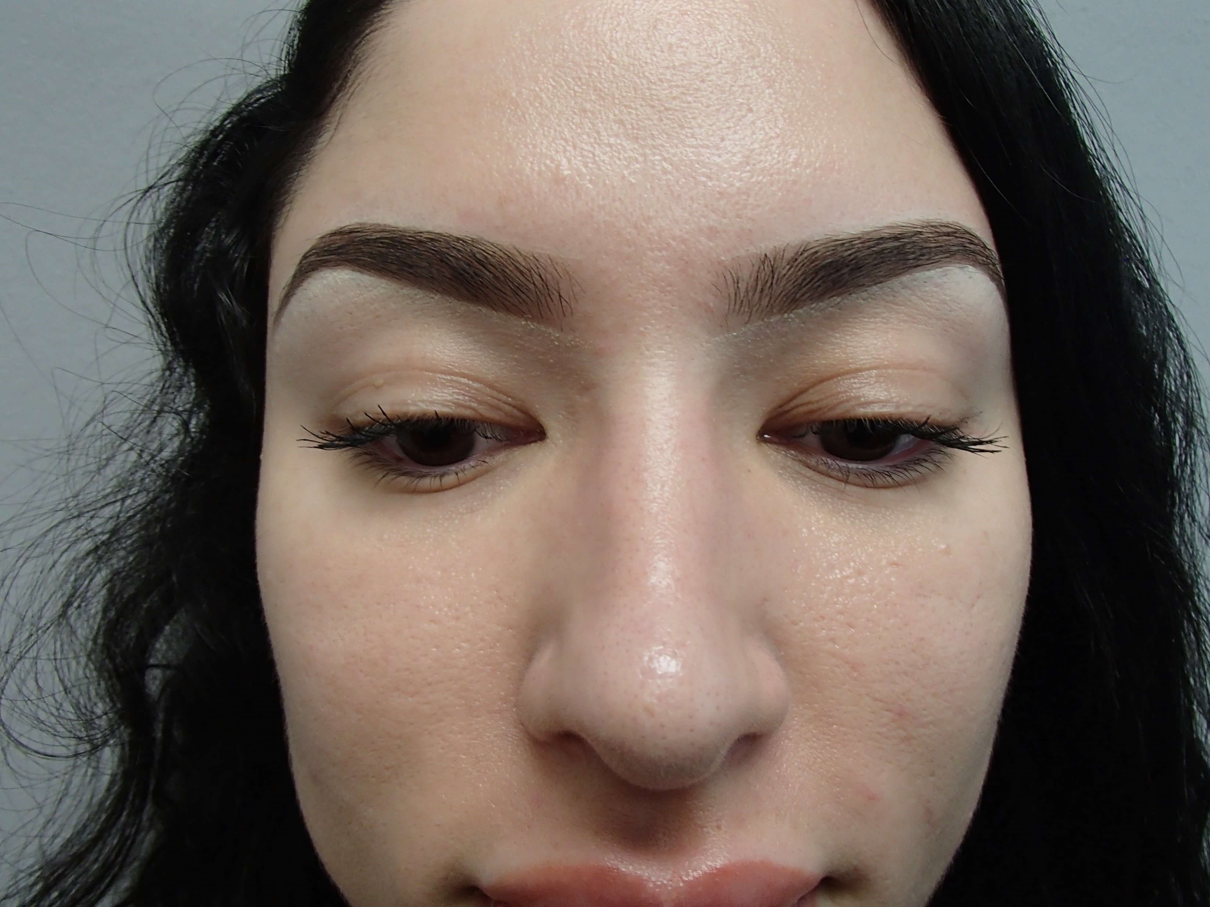 Rhinoplasty (Nose Job) After