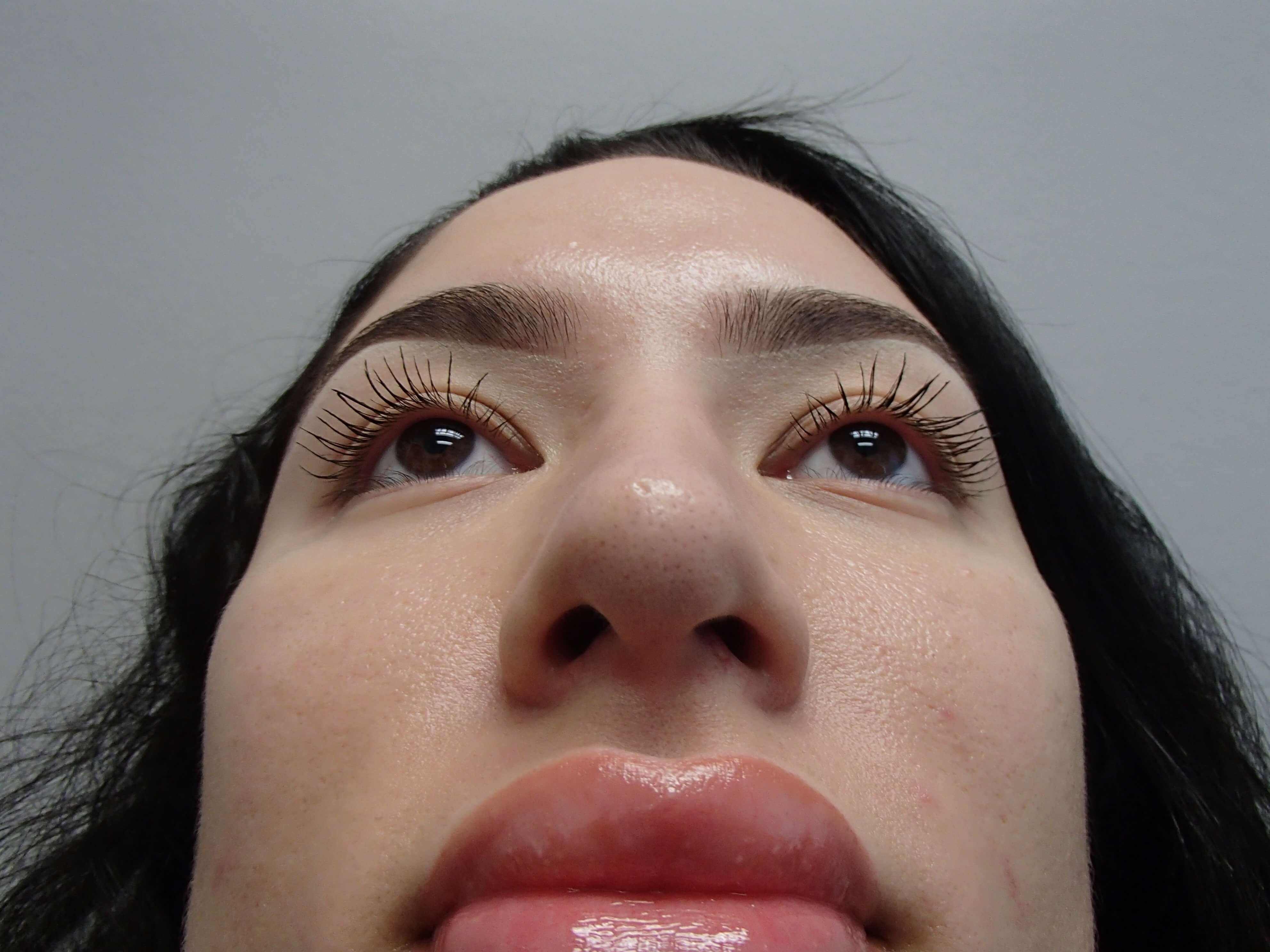Rhinoplasty (Nose Job) After