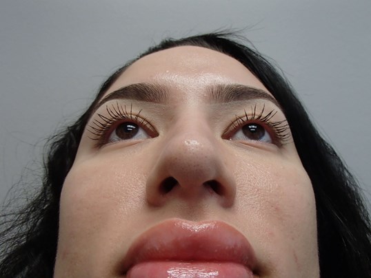 Rhinoplasty (Nose Job) After