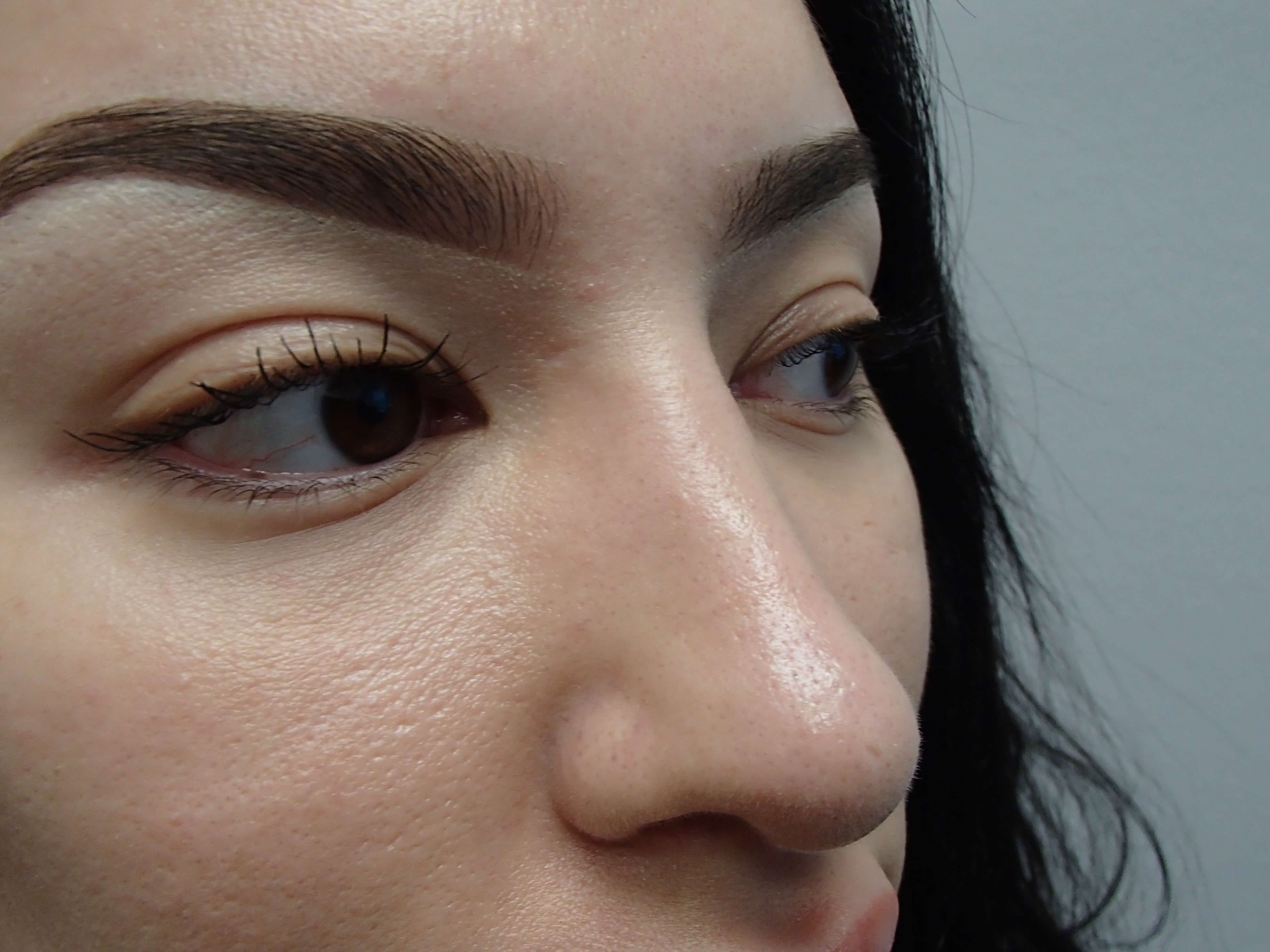 Rhinoplasty (Nose Job) After