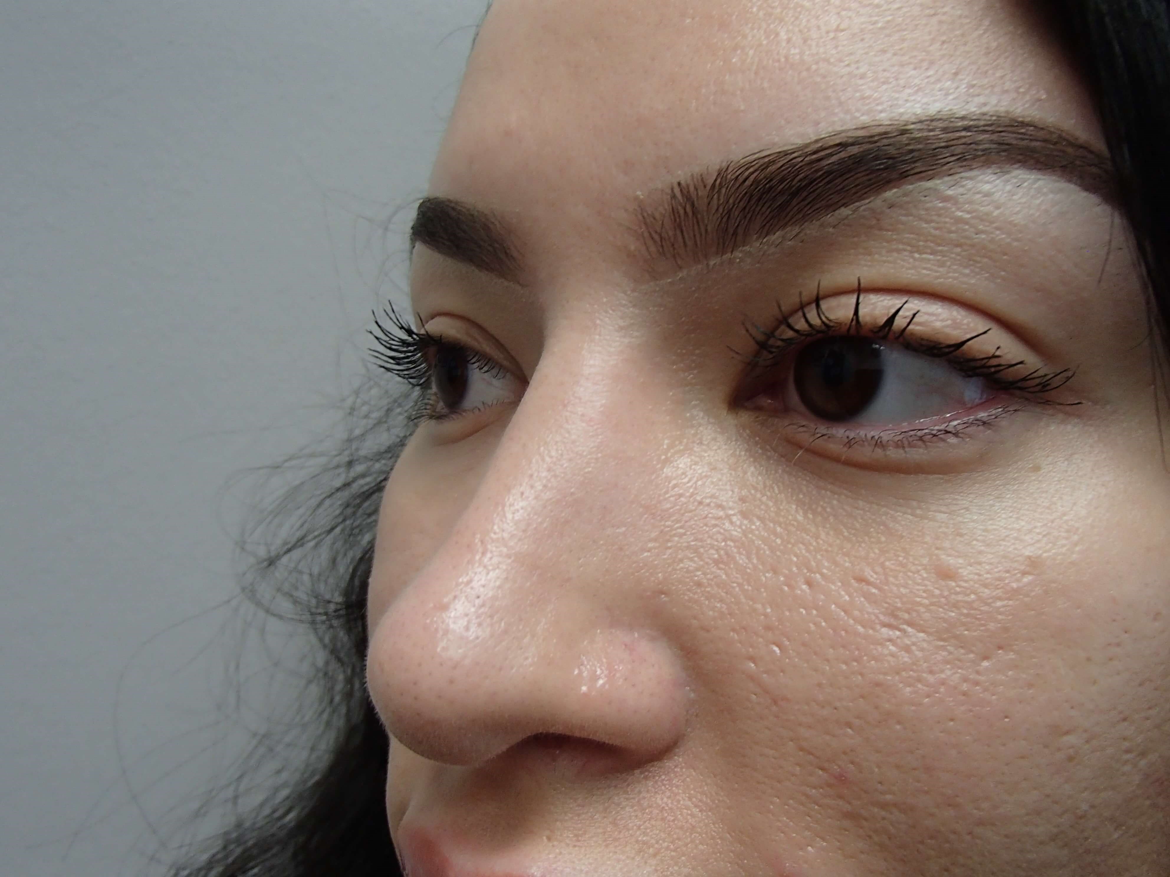 Rhinoplasty (Nose Job) After