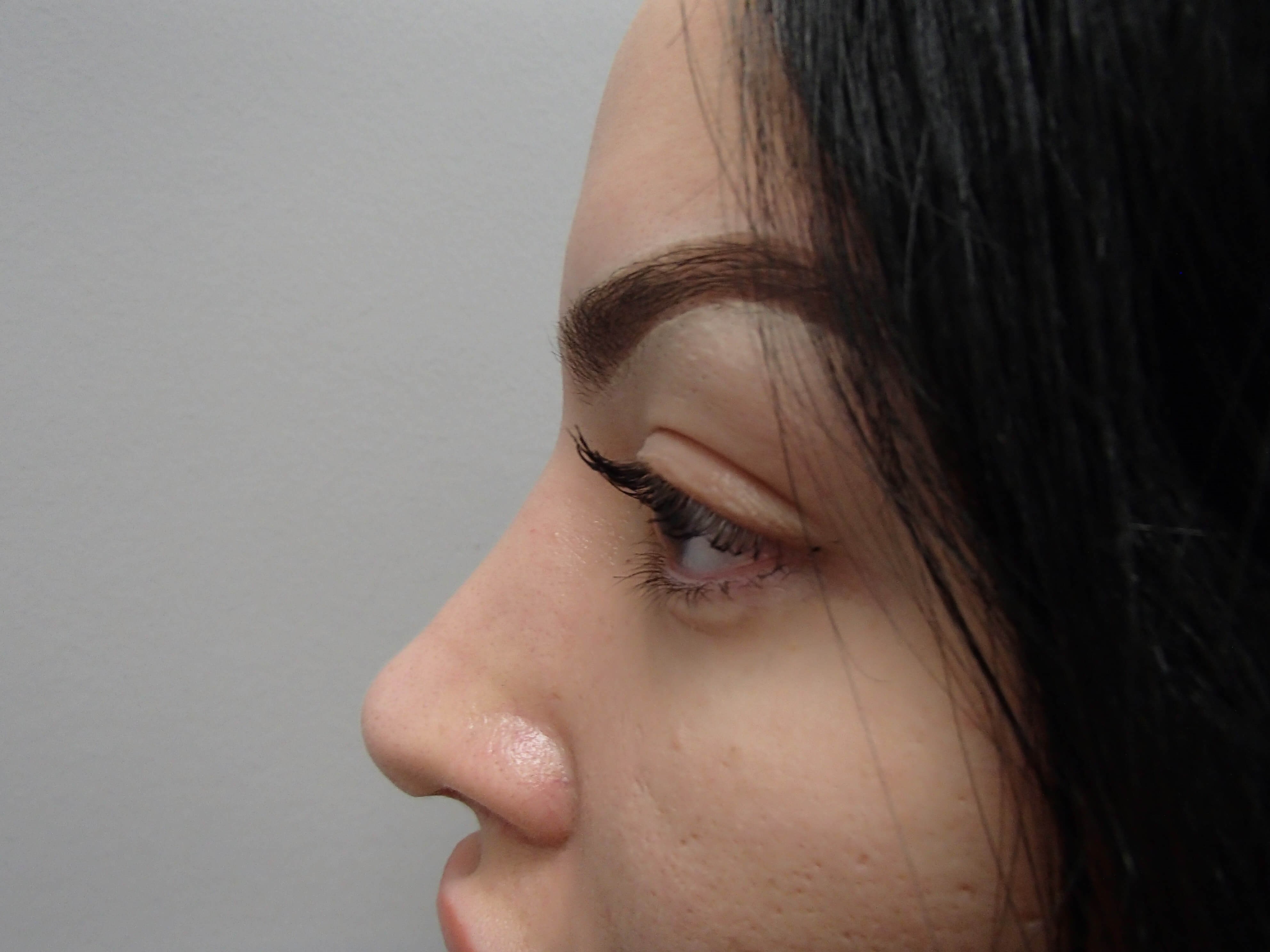 Rhinoplasty (Nose Job) After