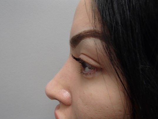 Rhinoplasty (Nose Job) After
