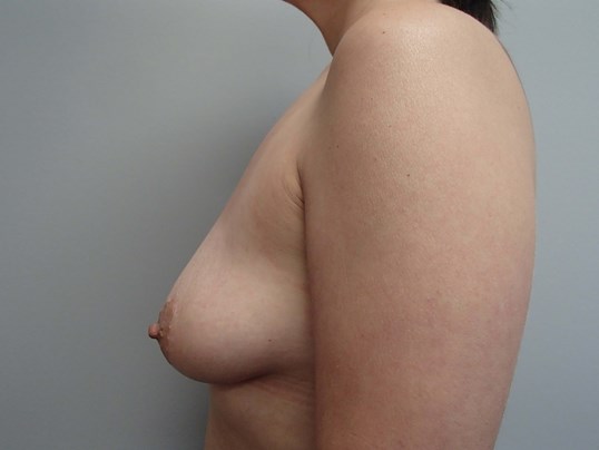 Breast Lift WITH Implants Before