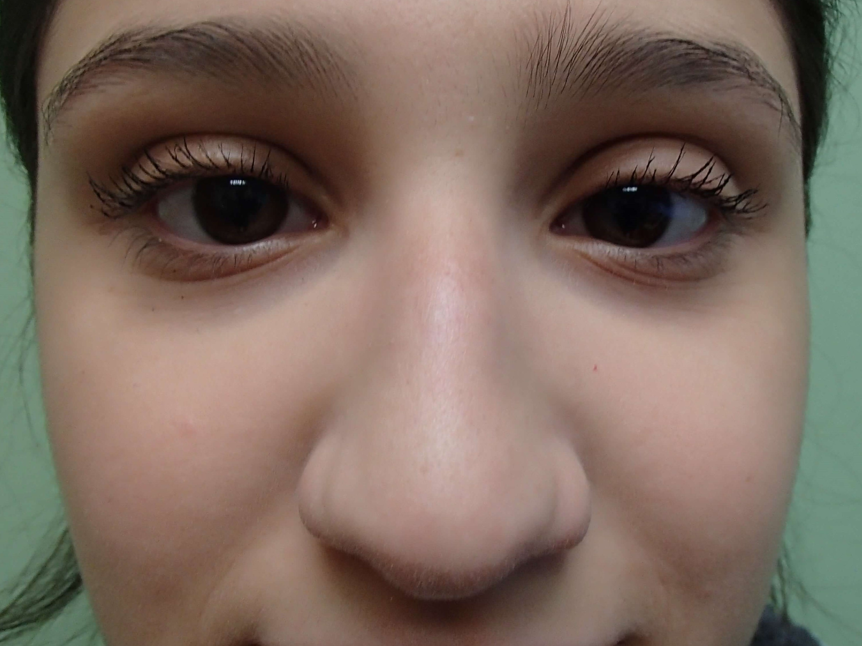 Rhinoplasty (Nose Job) Before
