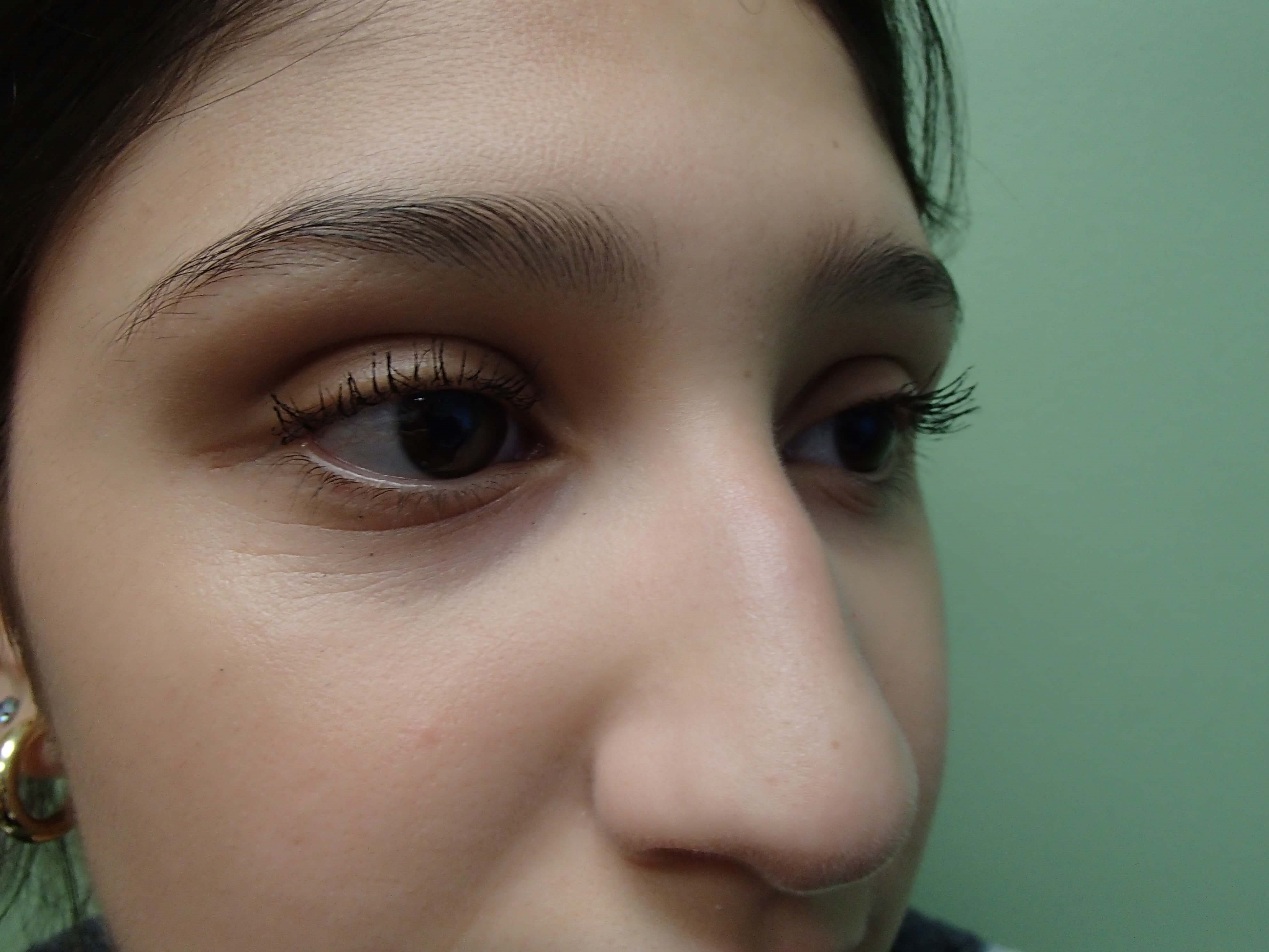 Rhinoplasty (Nose Job) Before