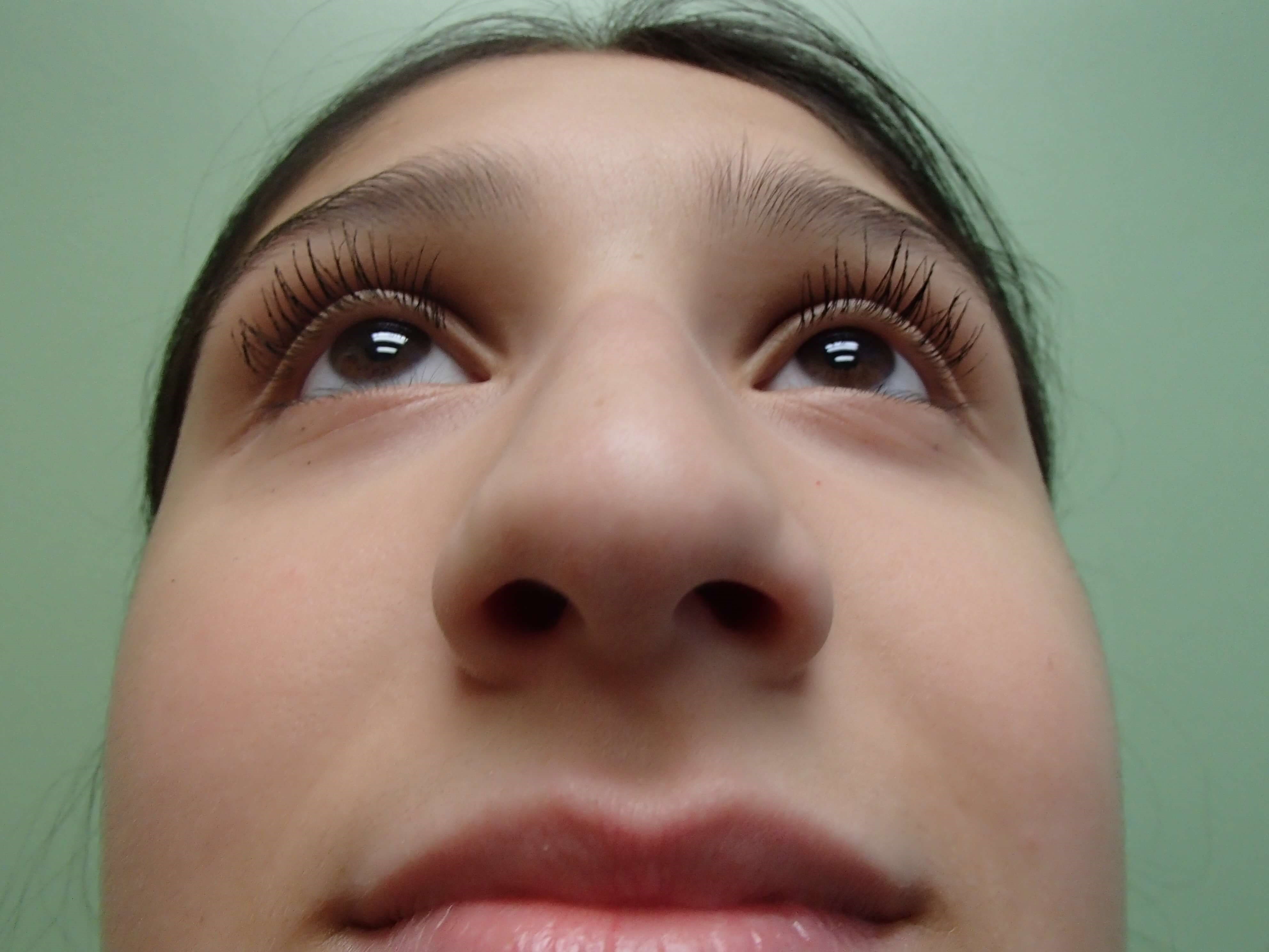 Rhinoplasty (Nose Job) Before