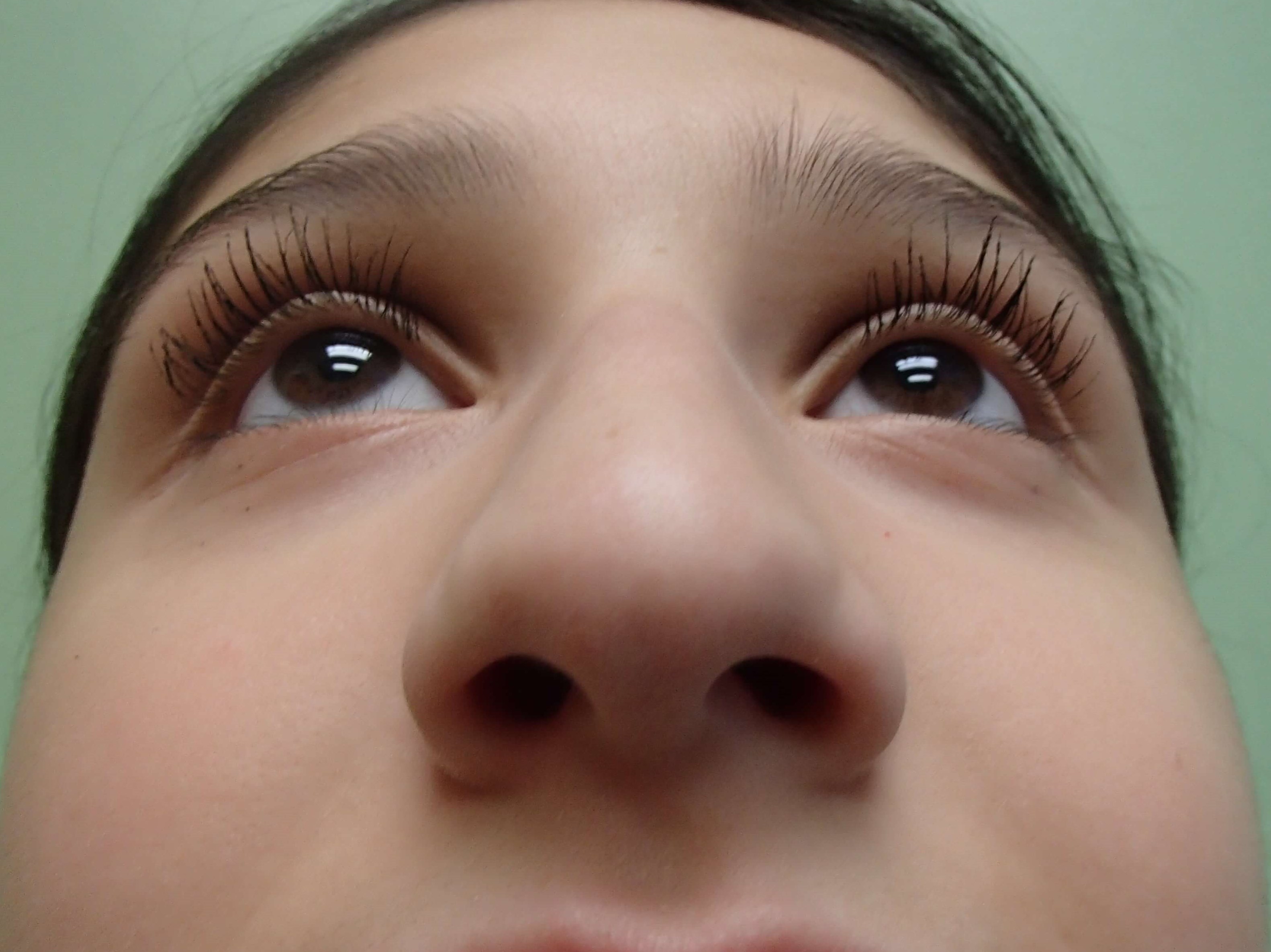 Rhinoplasty (Nose Job) Before