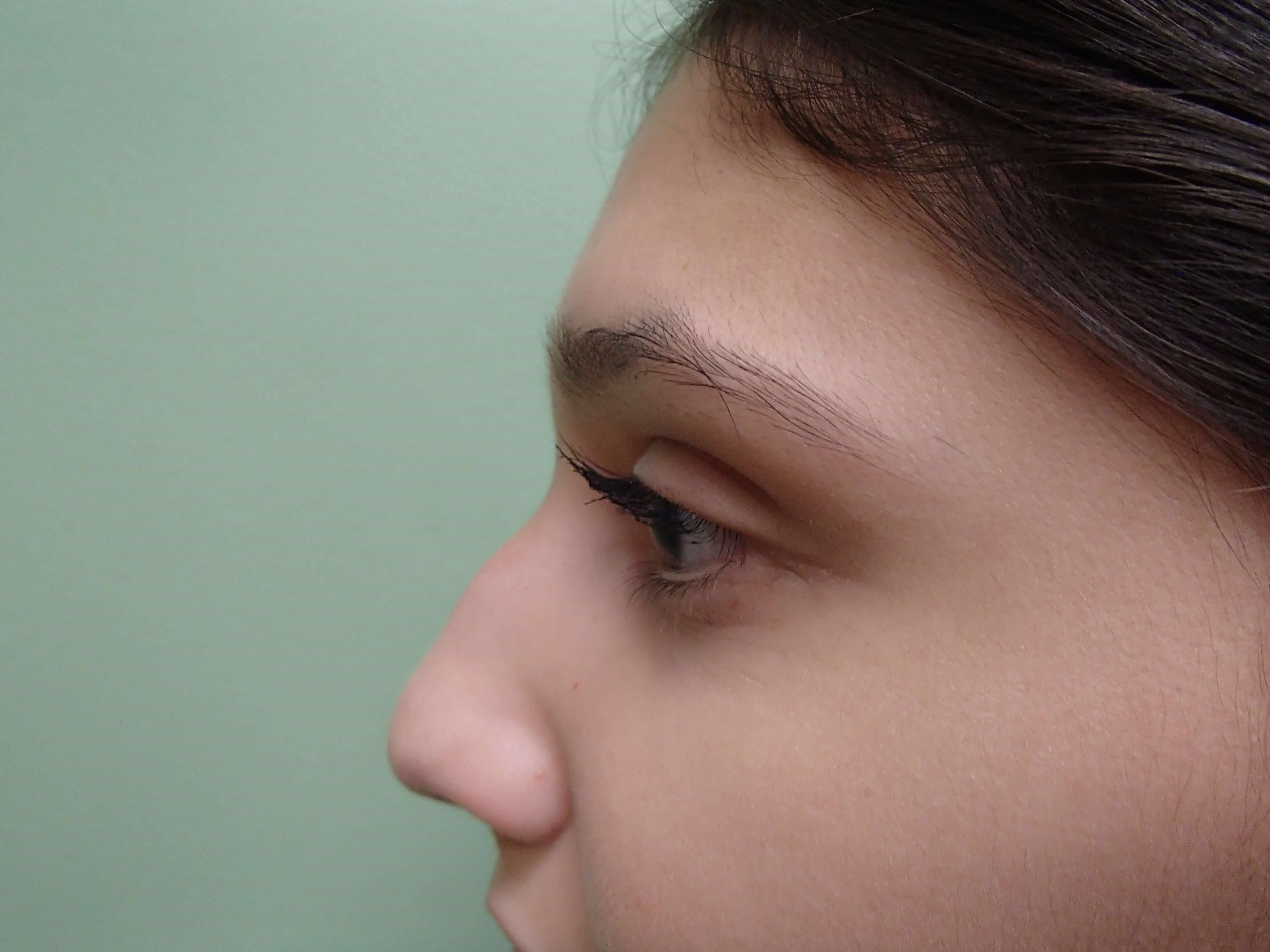 Rhinoplasty (Nose Job) Before
