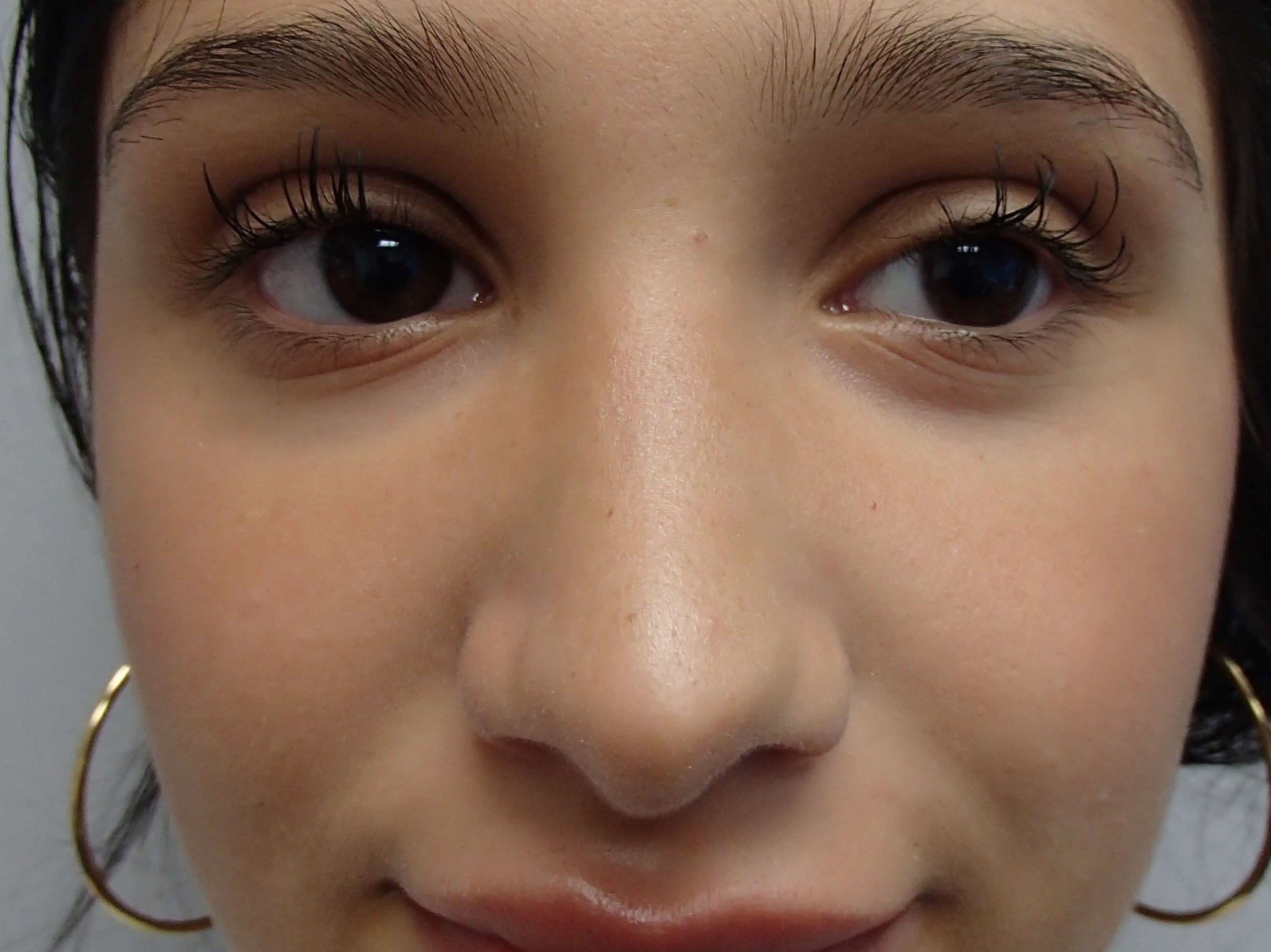 Rhinoplasty (Nose Job) After