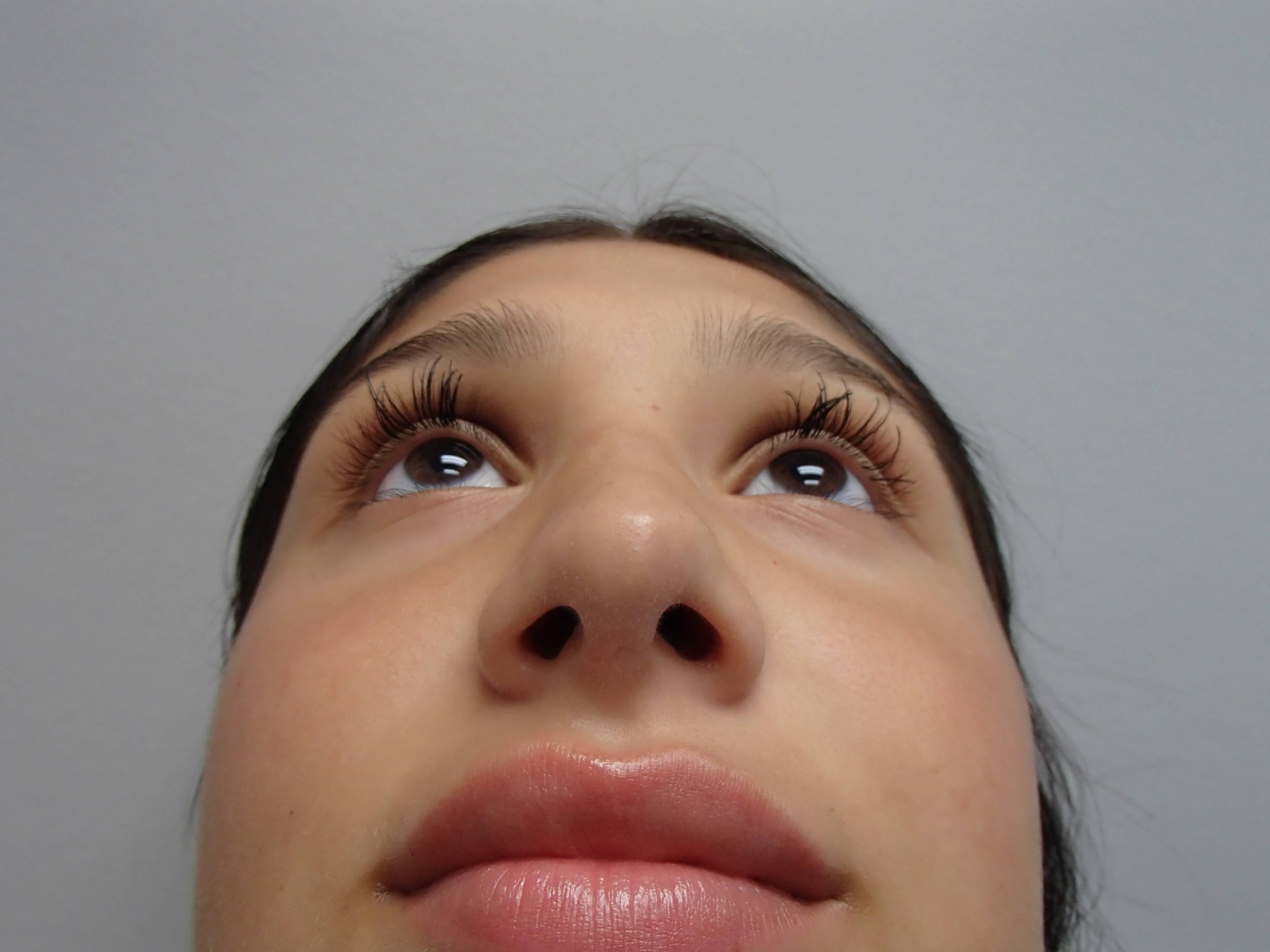 Rhinoplasty (Nose Job) After