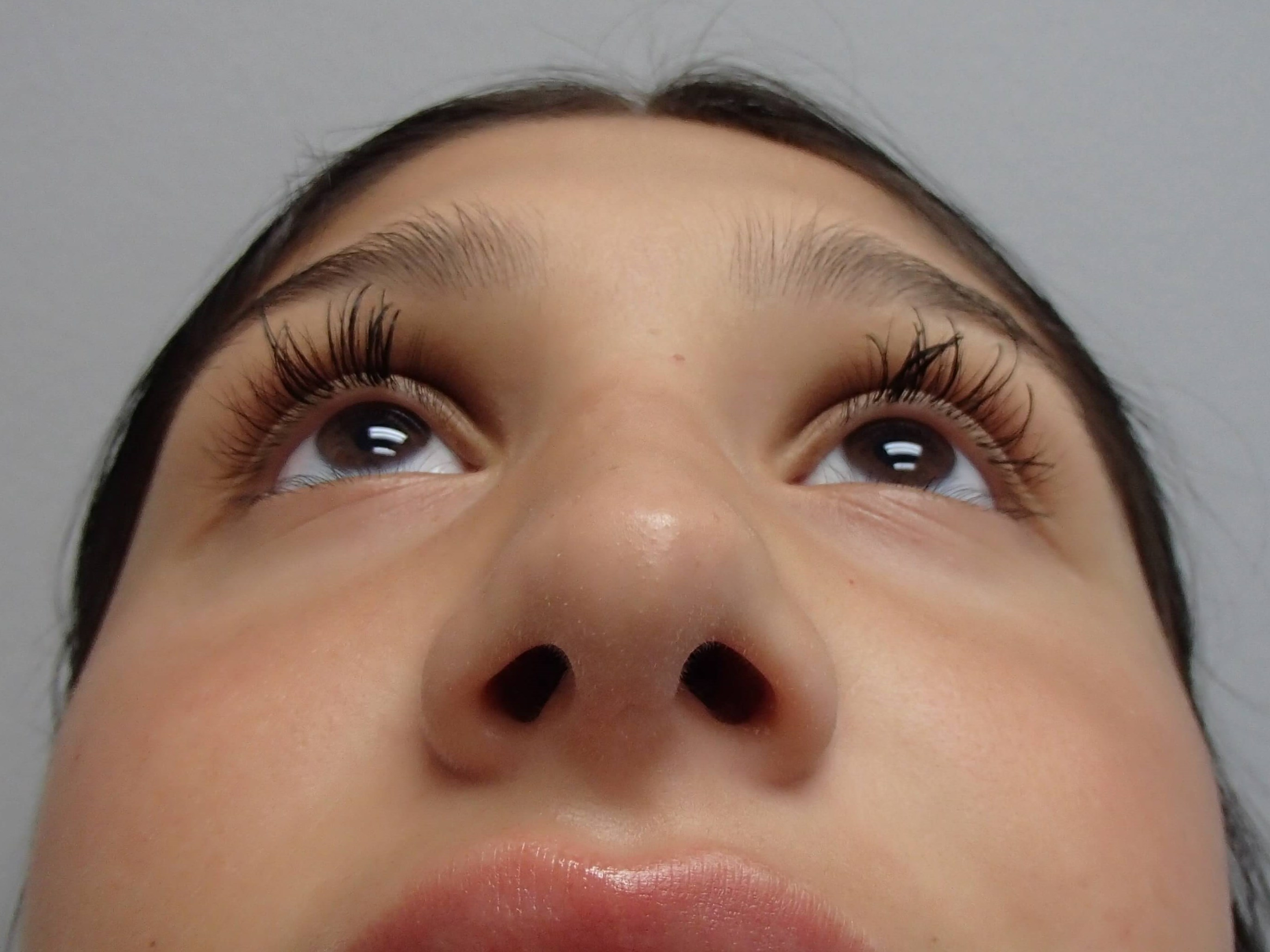Rhinoplasty (Nose Job) After
