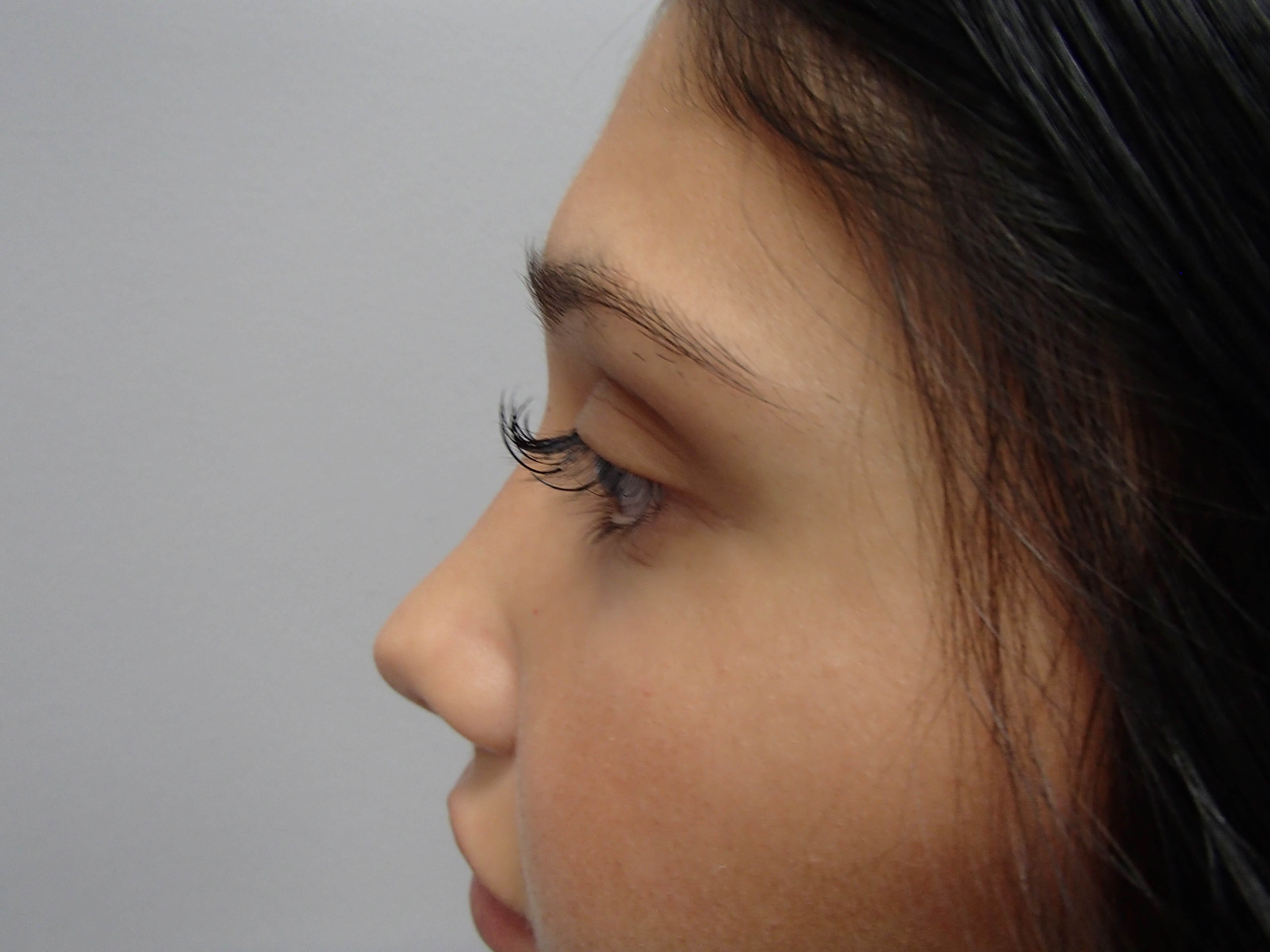 Rhinoplasty (Nose Job) After