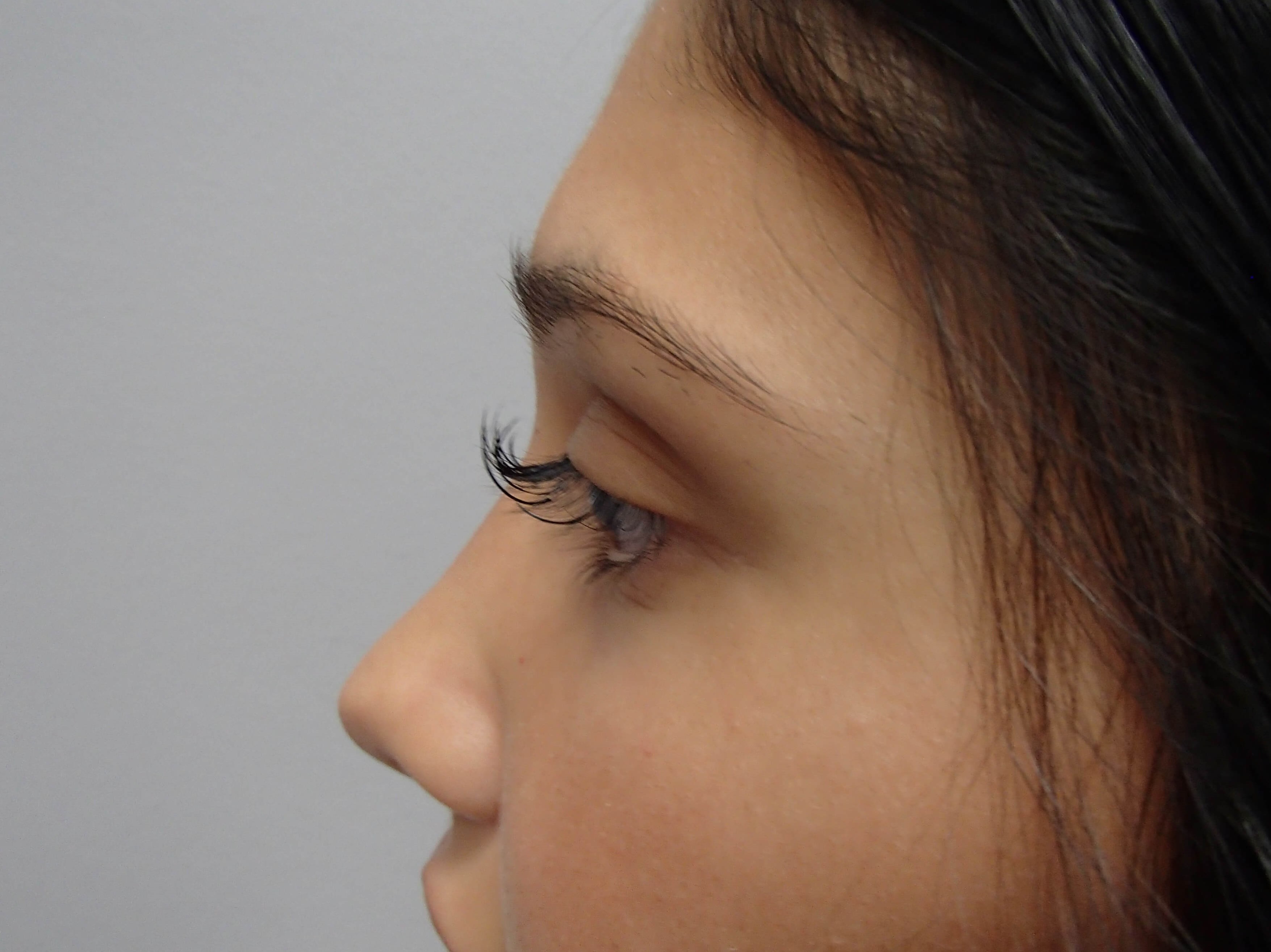 Rhinoplasty (Nose Job) After