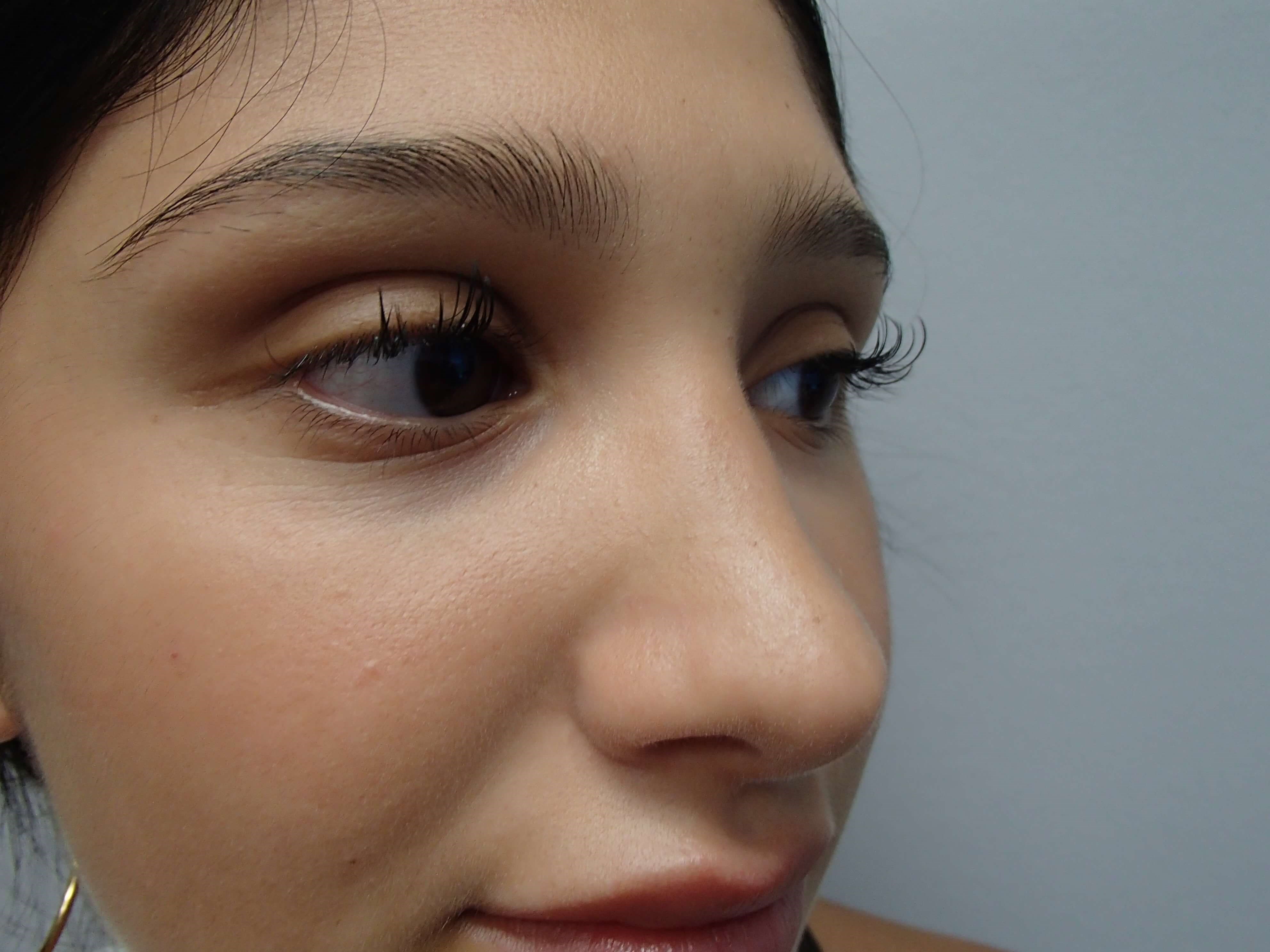 Rhinoplasty (Nose Job) After