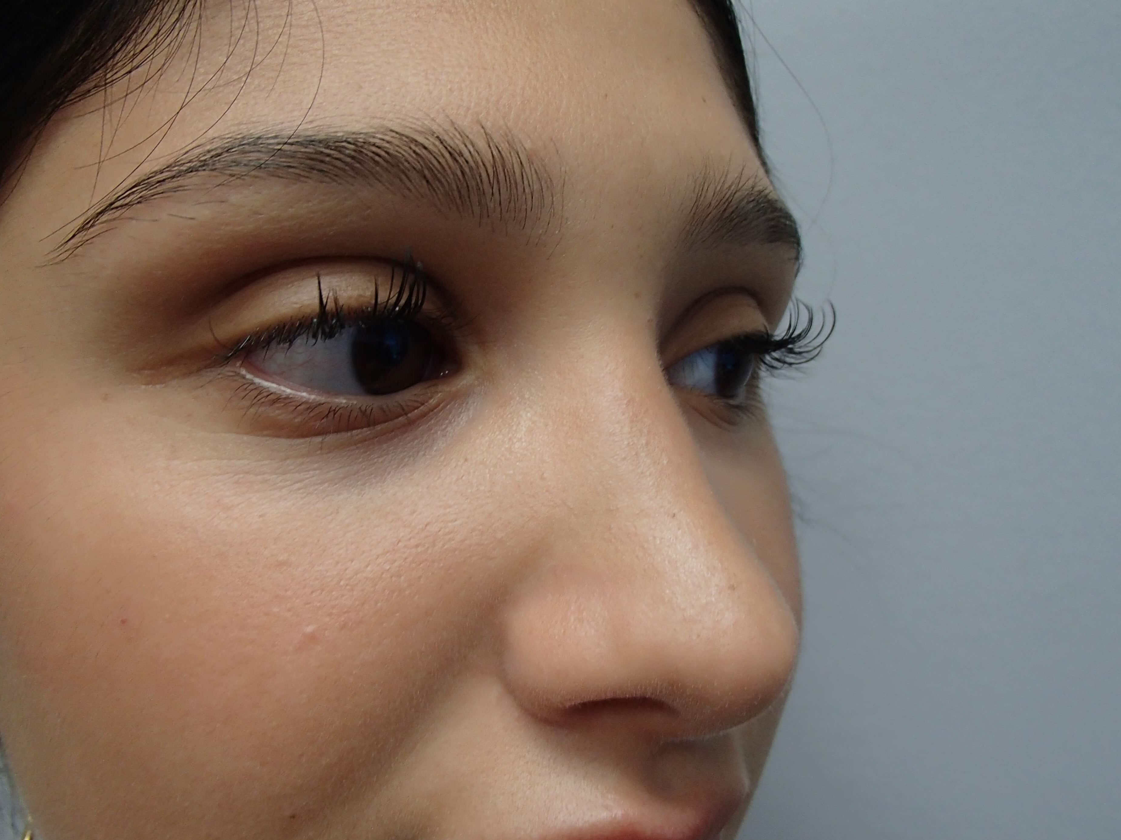 Rhinoplasty (Nose Job) After