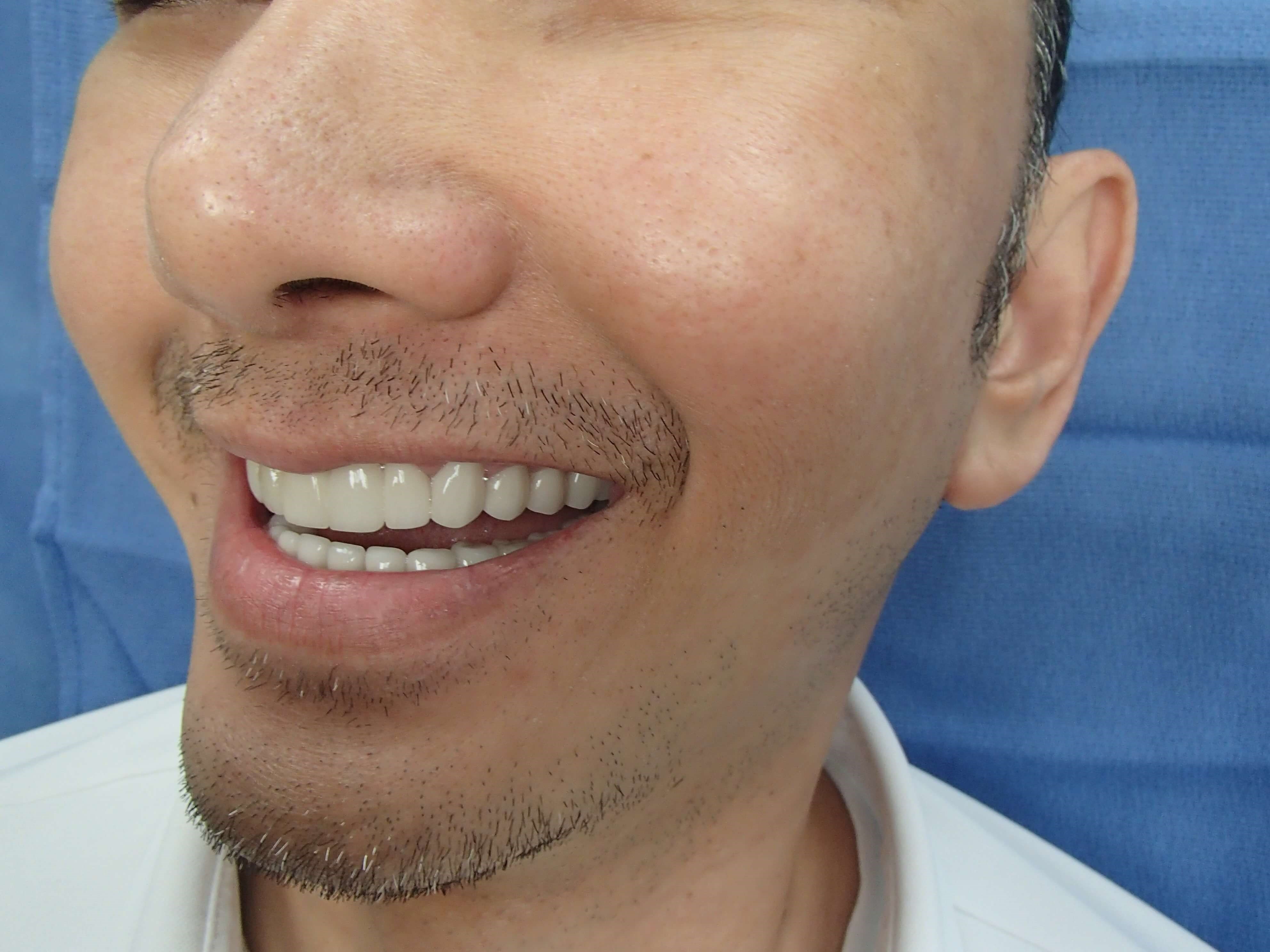Timeless Dimples Before